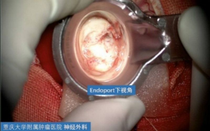 Highlights of Neurosurgery Operations at the Affiliated Tumor Hospital of Chongqing University: Resection of Giant Intraventricular Space-Occupying Lesions via Endoport